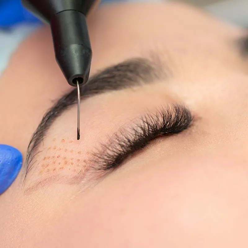 BLEFAROPLASTIA NO QUIRURGICA, medicos esteticos
