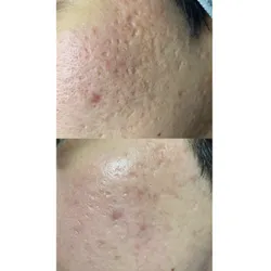 Tratamiento SECUELAS DE ACNE 