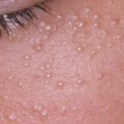     Skin Clear → Extracción especializada de miliums.