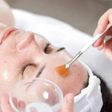Peeling Quimico