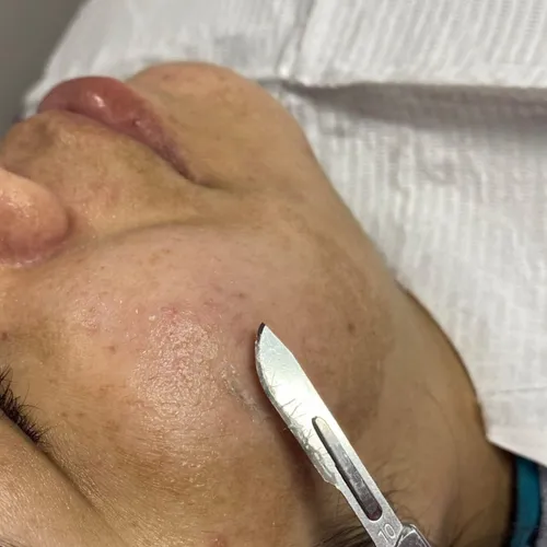 DERMAPLANING con higiene facial profunda 
