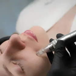 DERMAPEN con higiene facial profunda 