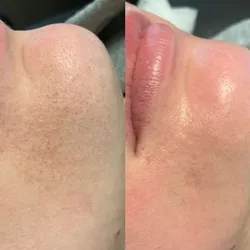 Limpieza facial Premiun 