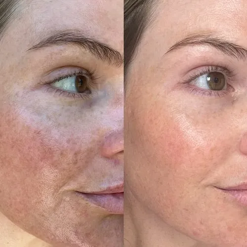 Yellow Peel (Peeling quimico)efectivo