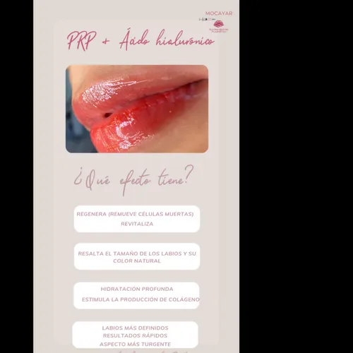 Labios - PRP + AH