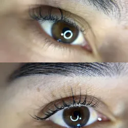 Reversión mala praxis lashlifting (externa)
