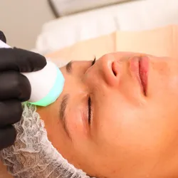 Radio Frecuencia Facial