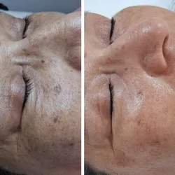 Limpieza facial y Exosomas 
