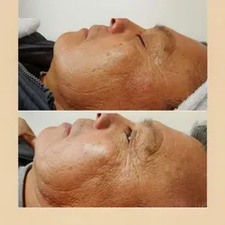 Radiofrecuencia multipolar facial 