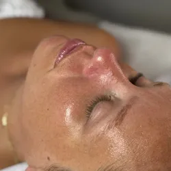 Limpieza facial profunda y peeling químico 
