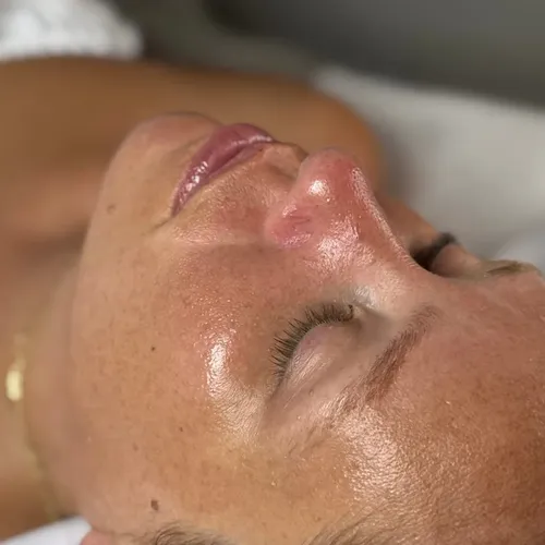Limpieza facial profunda y peeling químico 