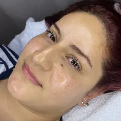 Peeling - essence peel