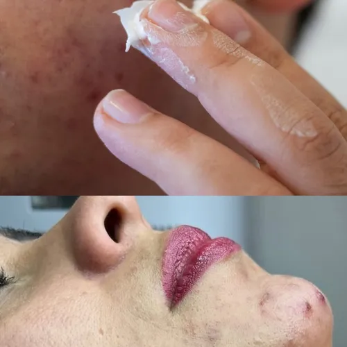 Tratamiento acne - skin reset 