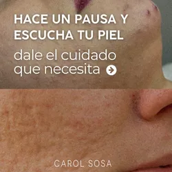 Tratamiento rosacea - calming facial