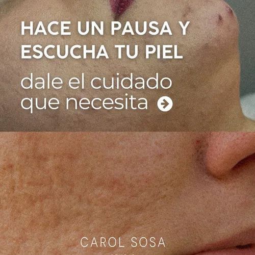 Tratamiento rosacea - calming facial