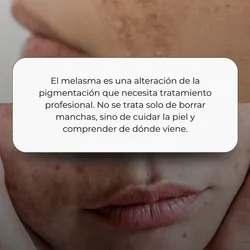 Tratamiento melasma 