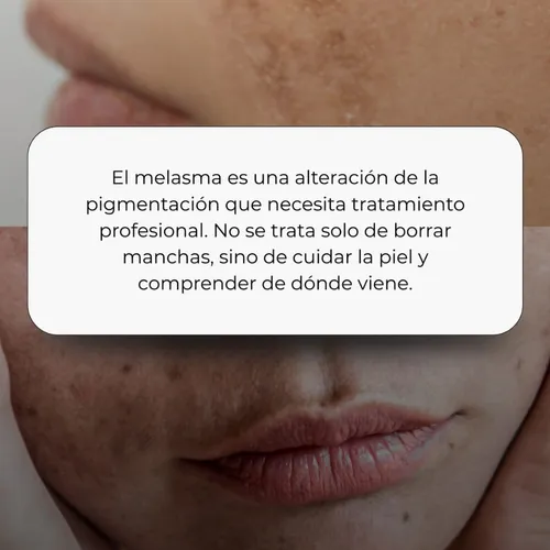 Tratamiento melasma 