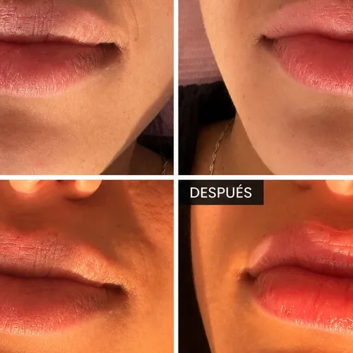 Sesión Hidratación de Labios 🌷