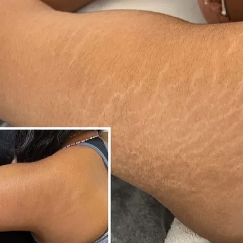 6 sesiones de peeling para ESTRÍAS 