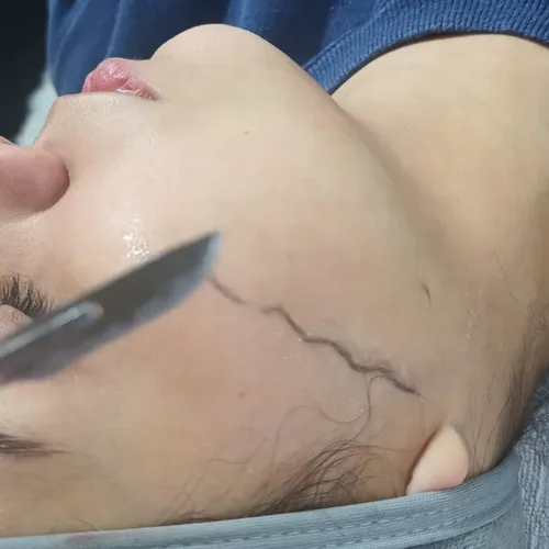 Dermaplaning, de Euphoria Estética