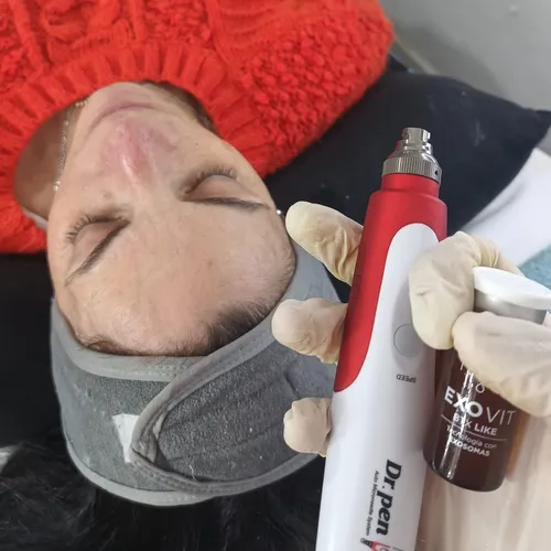 Dermapen con Exosomas, de Euphoria Estética