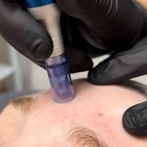 Microneedling + higiene profunda, de Cuidado de la piel 