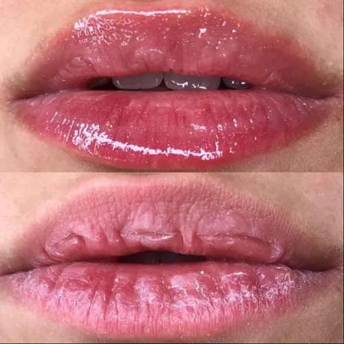 Hydra Lips 