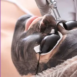 Hollywood Peel Laser Netcell + Limpieza Facial