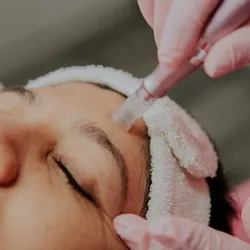 Limpieza+ Microneedling