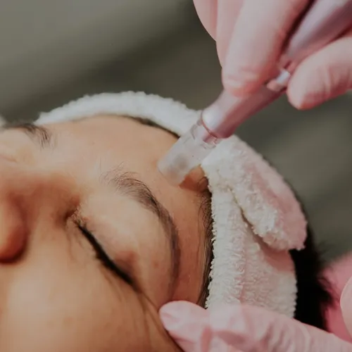 Limpieza+ Microneedling