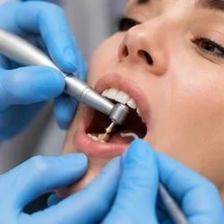 Arreglos de caries 