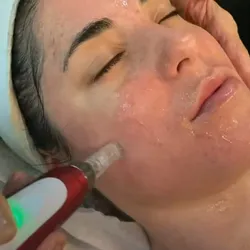 Microneedling con Dermapen + Exosomas