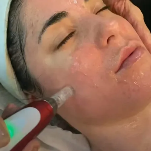 Microneedling con Dermapen + Exosomas