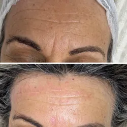 Microneedling (dermapen)