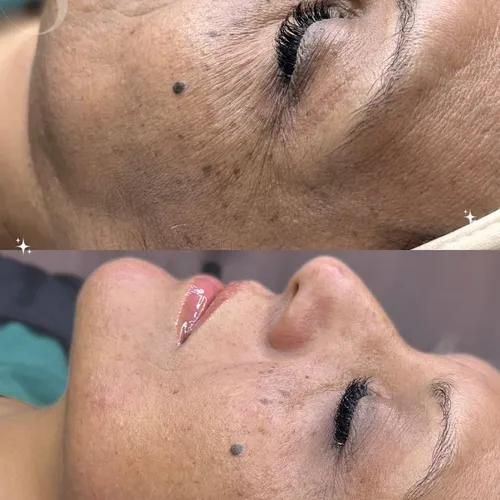 Tratamiento Skin Detox