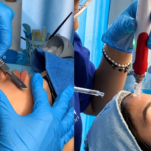 DERMAPLANING+ MICRONEEDLING