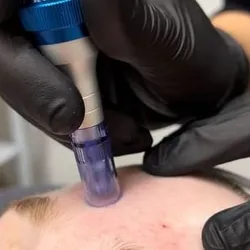 Limpieza facial con microneedling