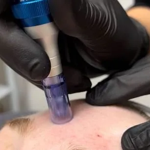 Limpieza facial con microneedling