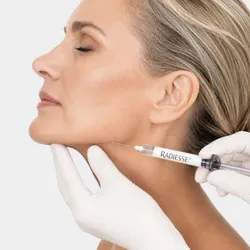 Radiesse® | Bioestimulación y firmeza