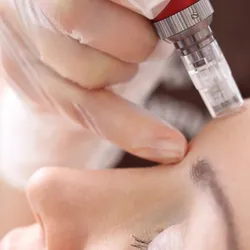 Tratamiento Antiacné con microneedling