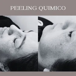 Peeling Químico