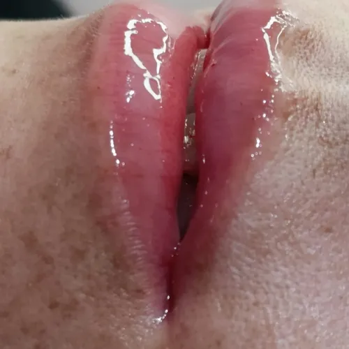 Hidra Lipss |Microneedling en labios 