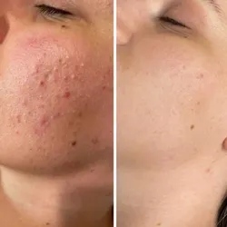 Tratamiento para acné o rosácea con luz pulsada ipl 