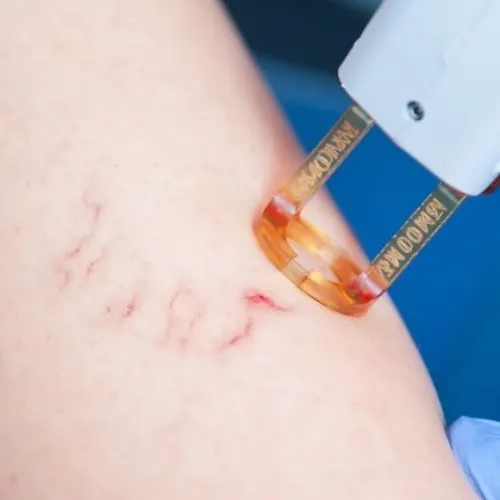 Tratamiento para varices con láser