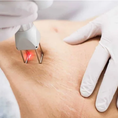 Tratamiento para estrias con láser