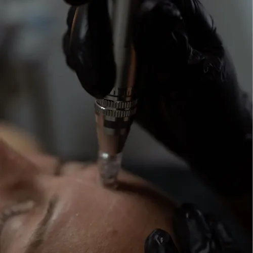 Microneedling, de Malena Skin