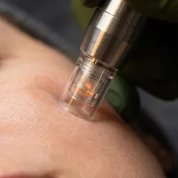 Dermapen microneedling