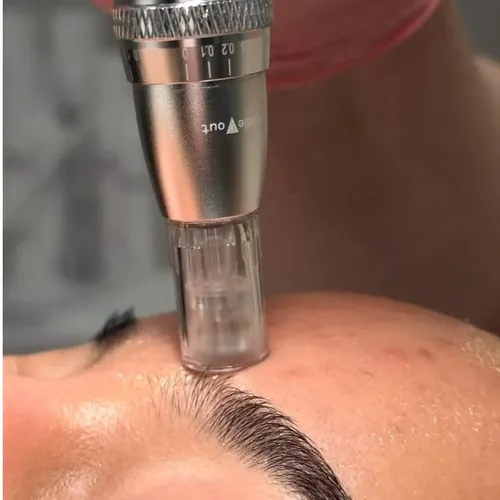 Microneedling + higiene facial