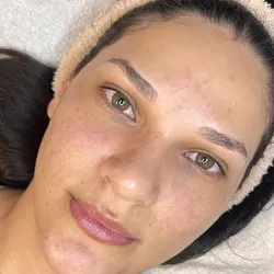 Peeling Facial