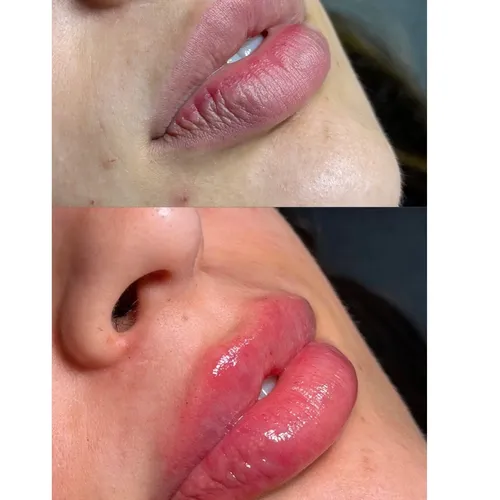 Hydralips / Bblips, de Glows by Aurora